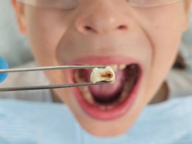 Best Emergency Tooth Extraction in Luverne, AL